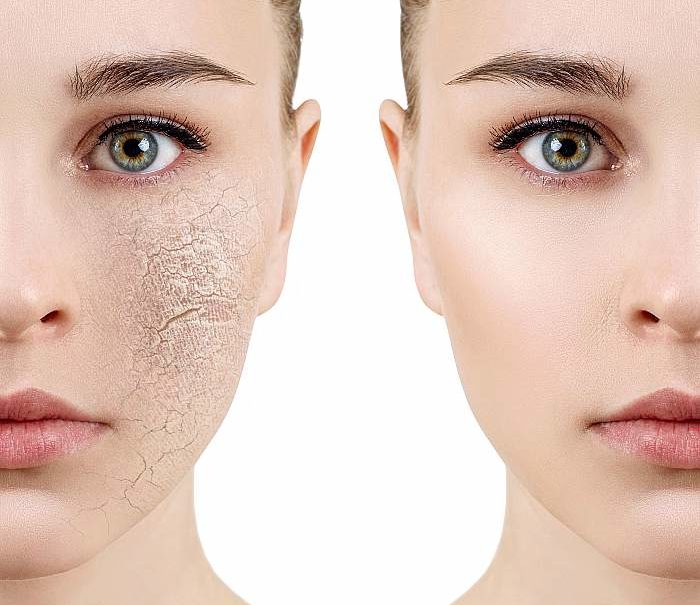 wysuszenie skóry twarzy przez szampon