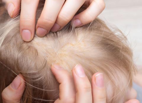 swędzenie skóry głowy u dzieci szampon